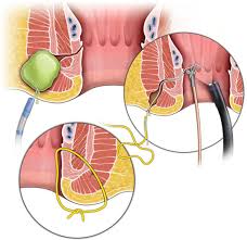 Crohn’s_Disease_Treatment