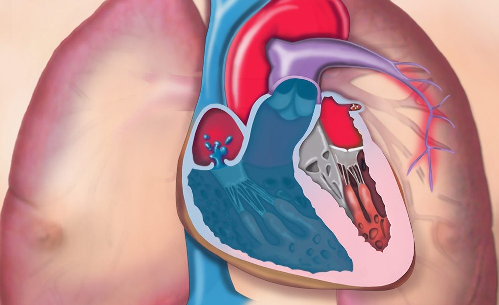 Pulmonary_Arterial_Hypertension_Treatment_Market