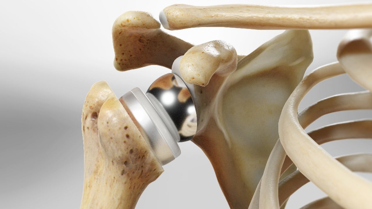 Reverse_Shoulder_Arthroplasty