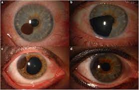 Uveal_Melanoma_Treatment