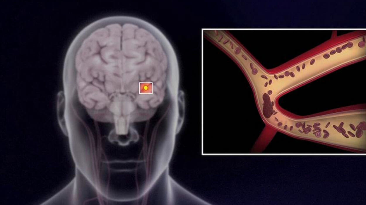 Acute_Ischemic_Stroke_Drugs_Market