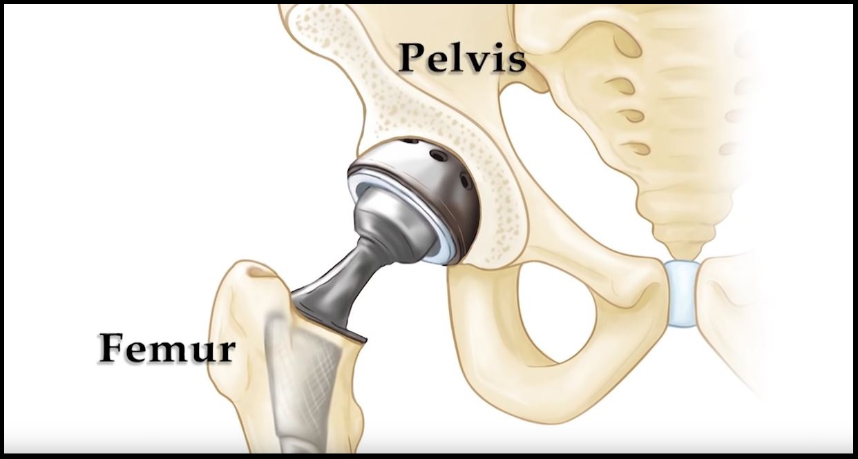 Artificial_Hip_Prosthesis