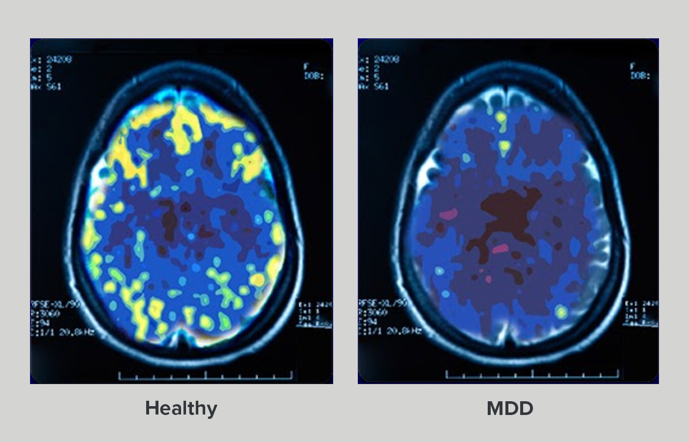 Major_Depressive_Disorder_(MDD)_Market1