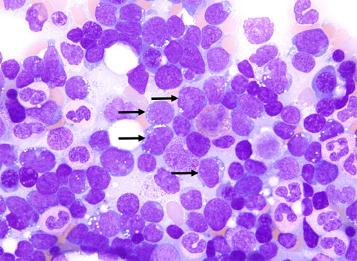 T-Cell_Acute_Lymphoblastic_Leukemia_Treatment_Market