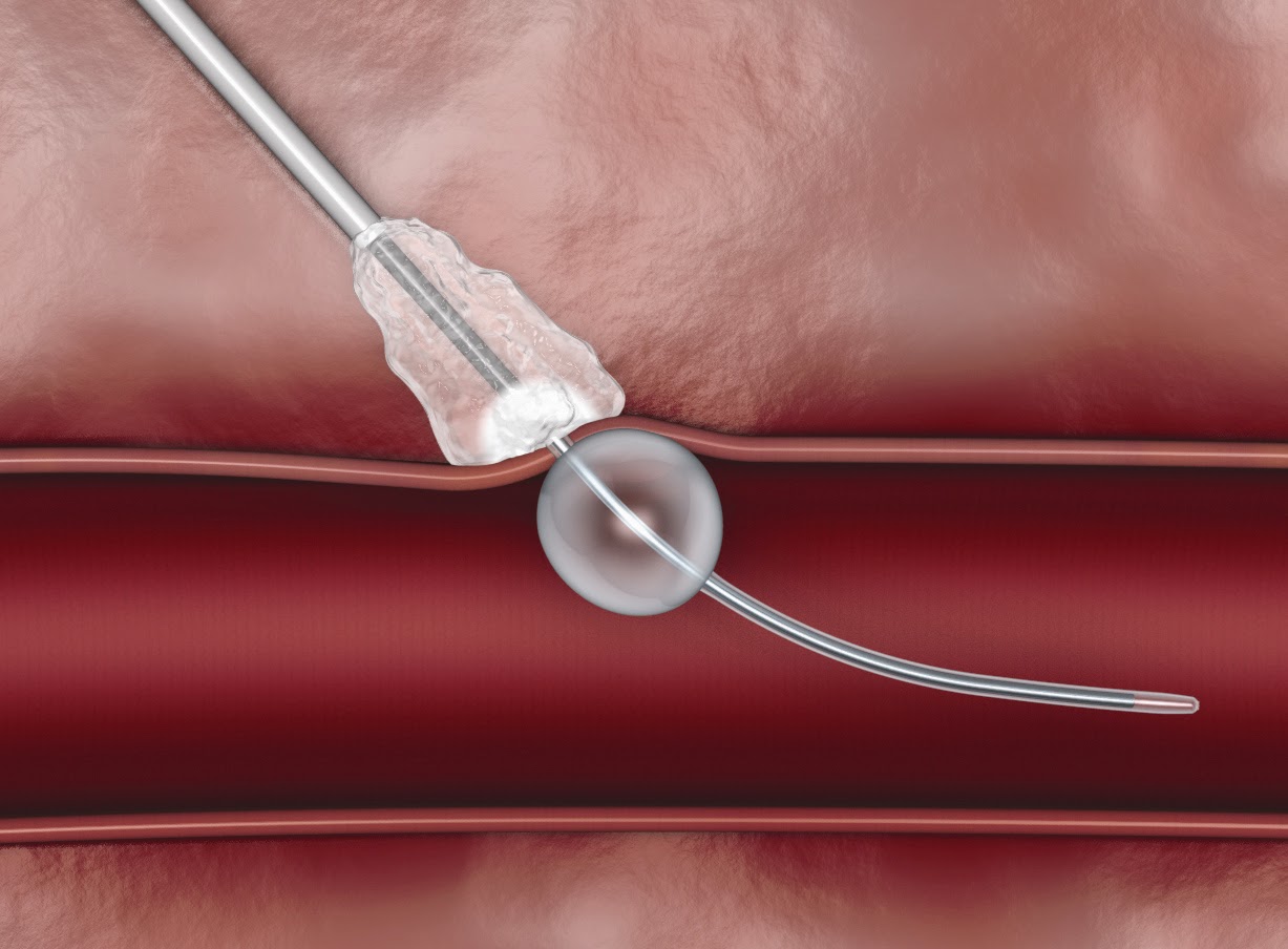 Vascular_Closure_Devices